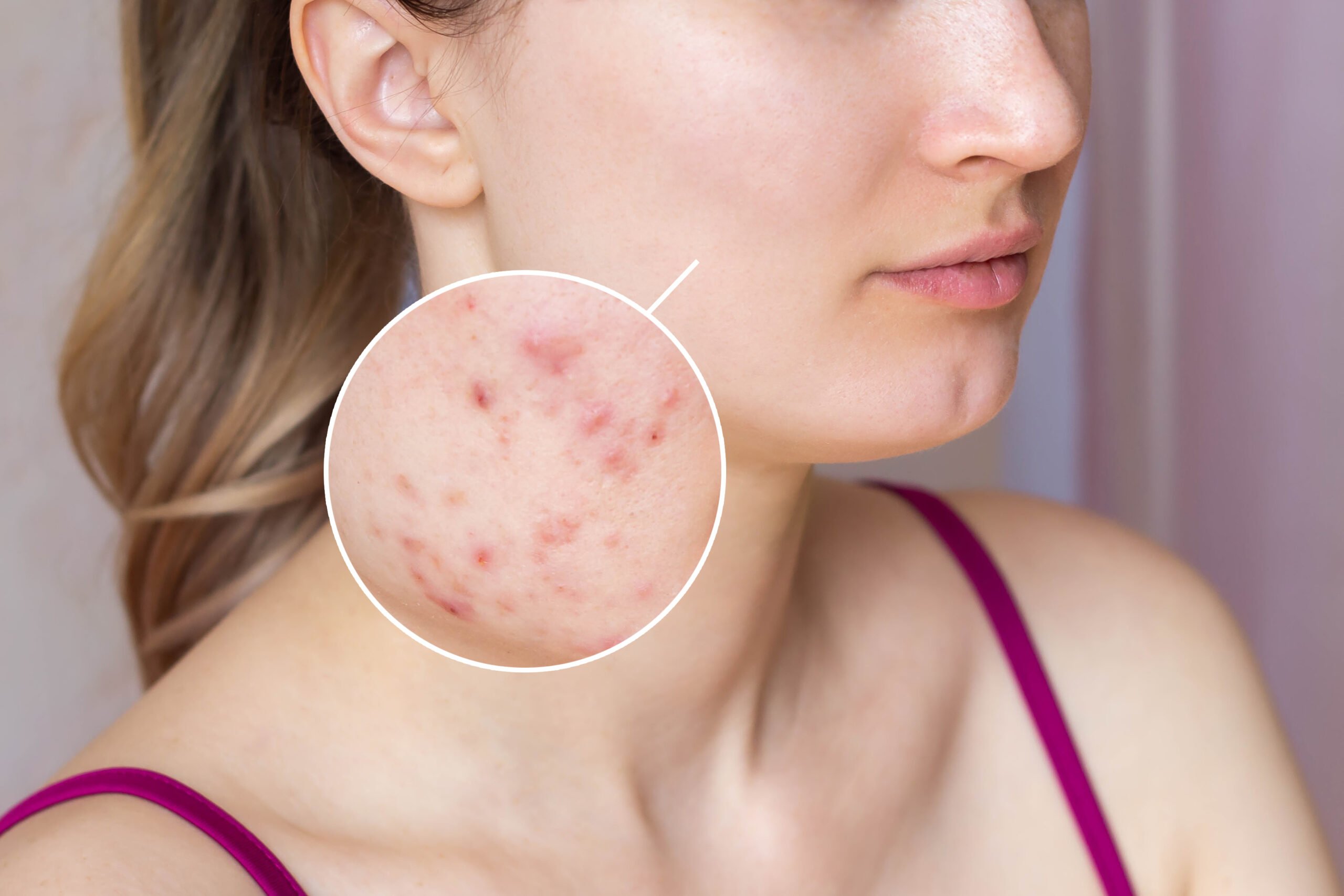 cropped-shot-young-womans-face-with-acne-skin-zoom-circle-pimples-red-scars-rash-cheeks